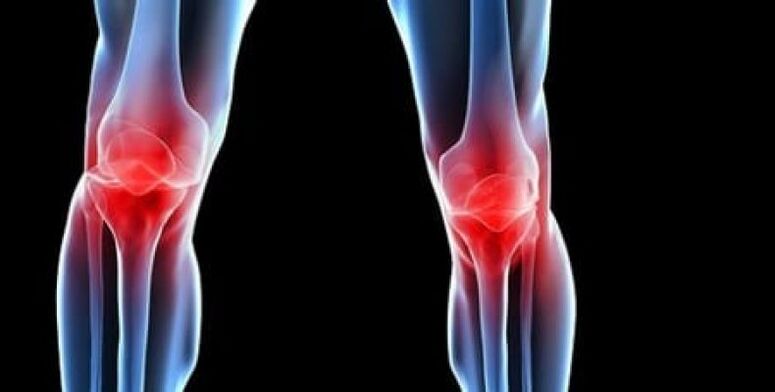 osteoarthritis of the knee