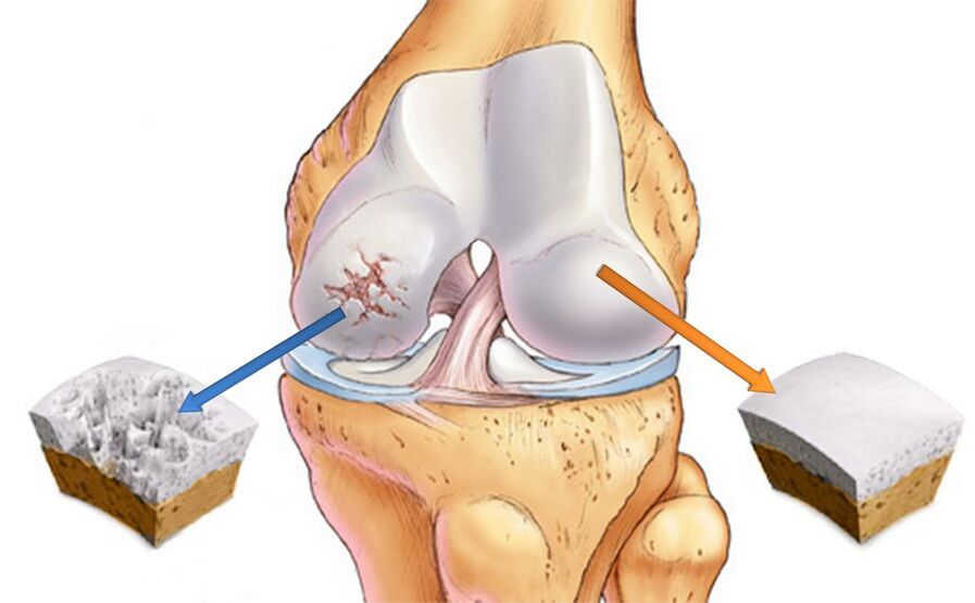 Arthritis of the knee joint