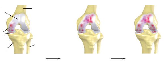 The arthrosis rate of the knee joint