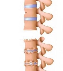 Stages of osteochondrosis ramps of the neck