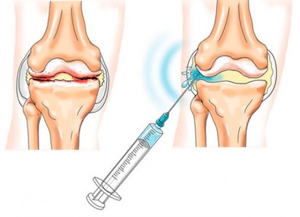 intra-articular injections for knee osteoarthritis