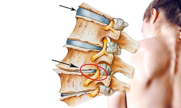 pinched nerve in the spine as a cause of back pain